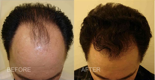 hair loss stopped by stem cell treatment